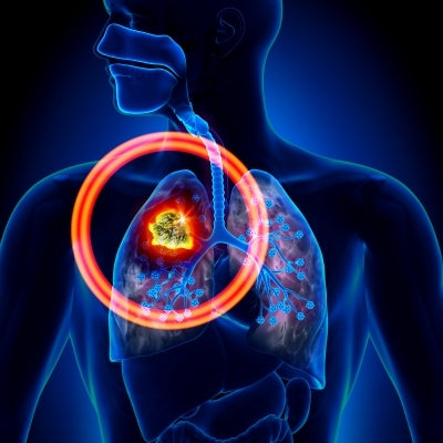 第一線不可逆標靶藥物afatinib與第一代可逆標靶藥物gefitinib治療罹患EGFR突變陽性非小細胞肺癌的療效比較